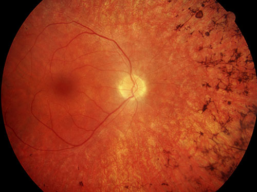 Netzhautbild bei Retinitis pigmentosa